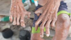 Pohuwato Tetapkan Status KLB Kusta, Wanggarasi Jadi Titik Pusat