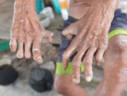 Pohuwato Tetapkan Status KLB Kusta, Wanggarasi Jadi Titik Pusat