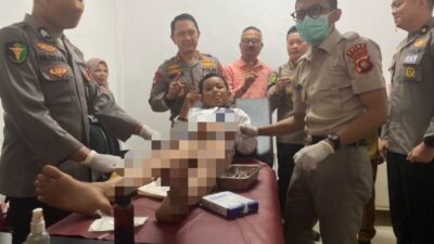 Sambut HUT ke-80 Bhayangkara, Polda Gorontalo Gelar Operasi Katarak hingga Khitanan Gratis